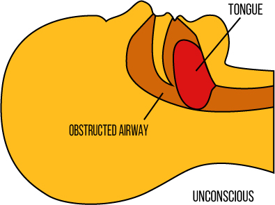 Obstructed-Airway