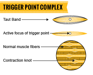 Trigger Point Injection, Myofascial Pain Treatment