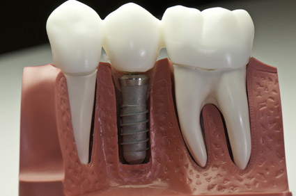 Can You Get Dental Implants If You Have Tmj?