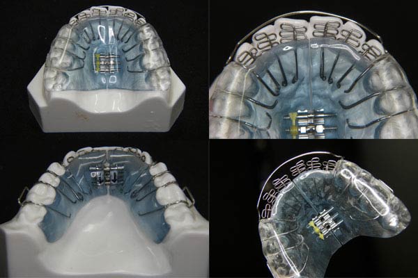 Orthodontic Treatment of Sleep Disorders