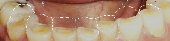 Grinding Teeth, Bruxism, Clenching and Anterior bracing