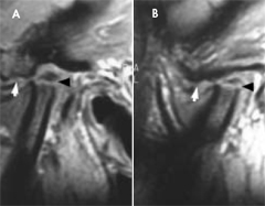 tmj-arthritis