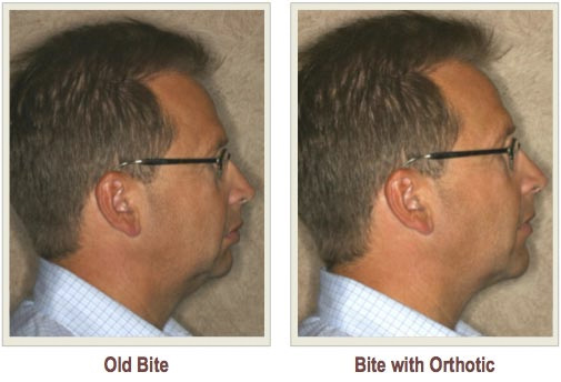 tmj-bite-orthotic