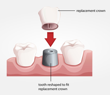 Dental Crowns and Bridges