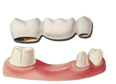 tmj-dental-bridge