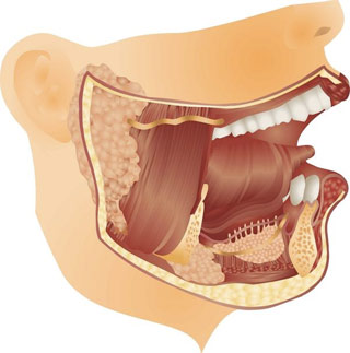 What causes a swollen tongue on one side?