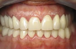 tmj-uneven-bite